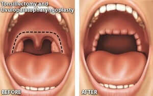 Tonsilenctomy