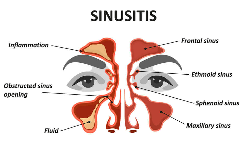 Sinusitis Diagram