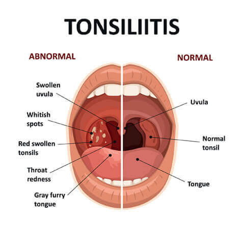 Tonsilitis diagram