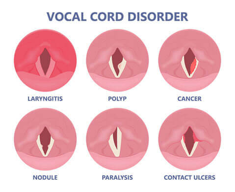 Vocal cord disorders diagram